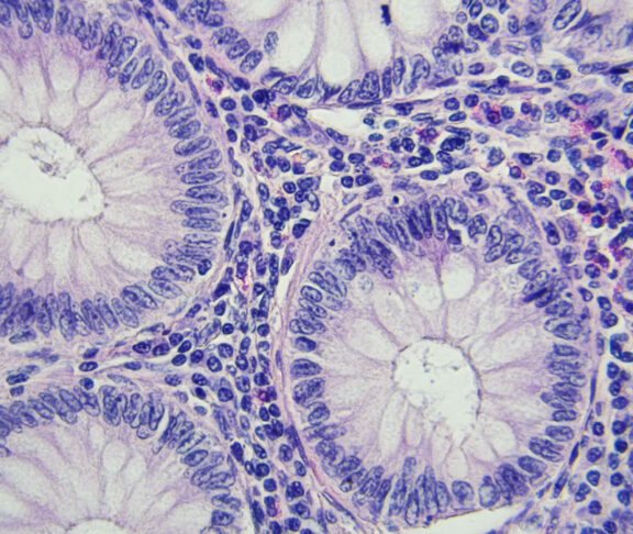 Colon cancer microscopic photography, magnification x400